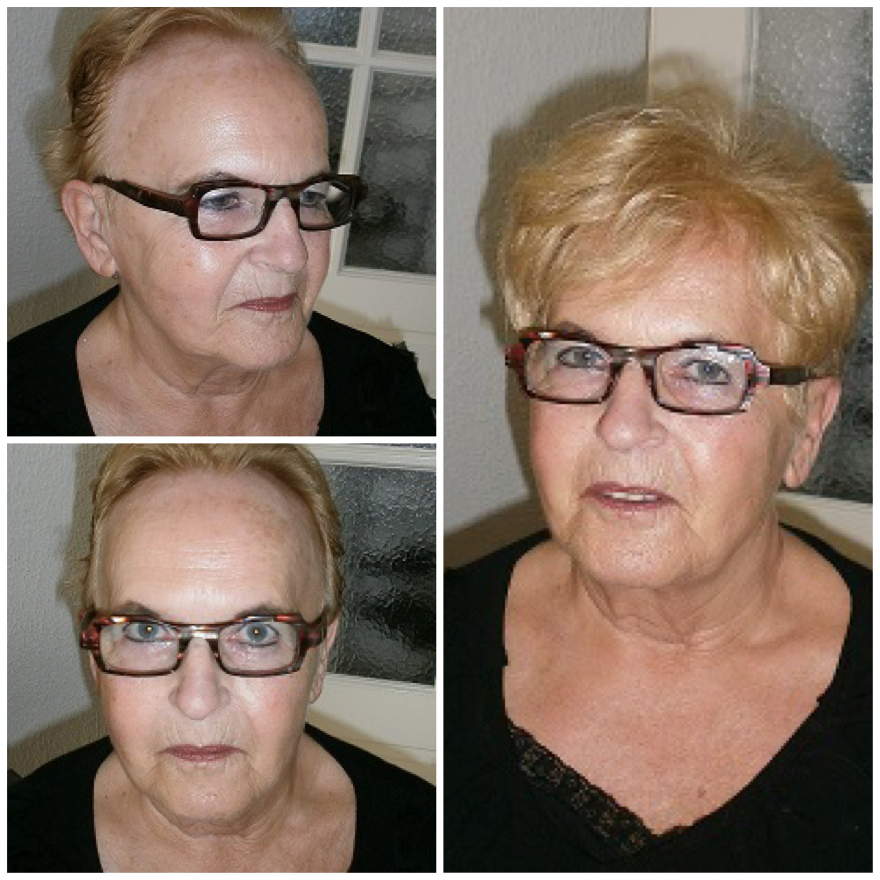 fibrosing alopecia